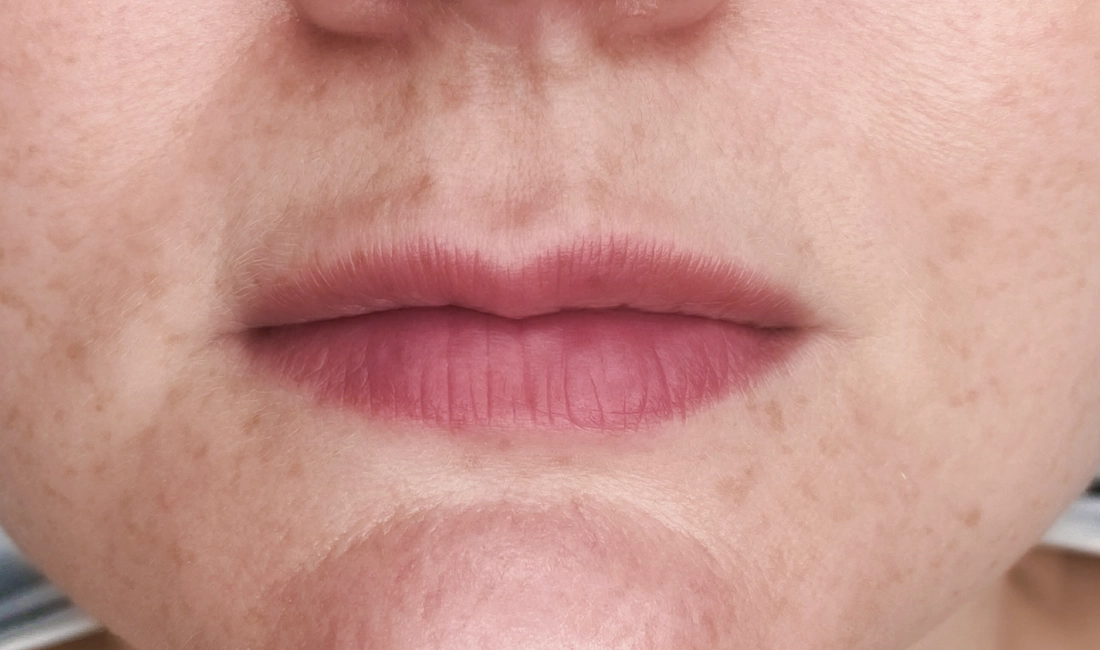 lippen_vorher